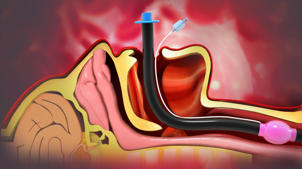 Why Do We Intubate Critical Care Practitioner